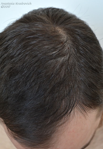 Лосьон Minox 5 против выпадения и для роста волос у мужчин