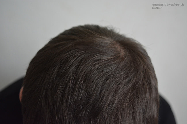 Лосьон Minox 5 против выпадения и для роста волос у мужчин